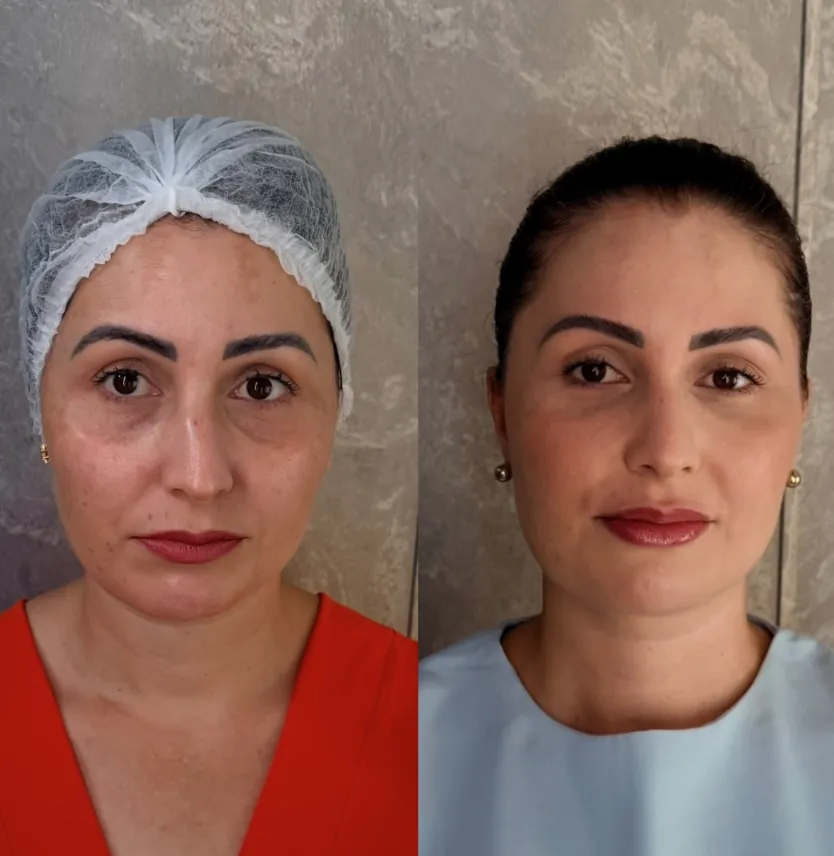 Comparação frontal antes e depois de tratamento facial no Instituto Dal Prá